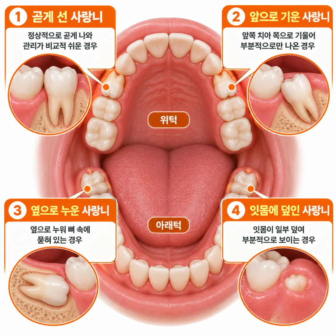 사랑니 네 개가 위아래 좌우에서 각각 다른 방향과 깊이로 나 있는 모습을 보여 주는 개념도