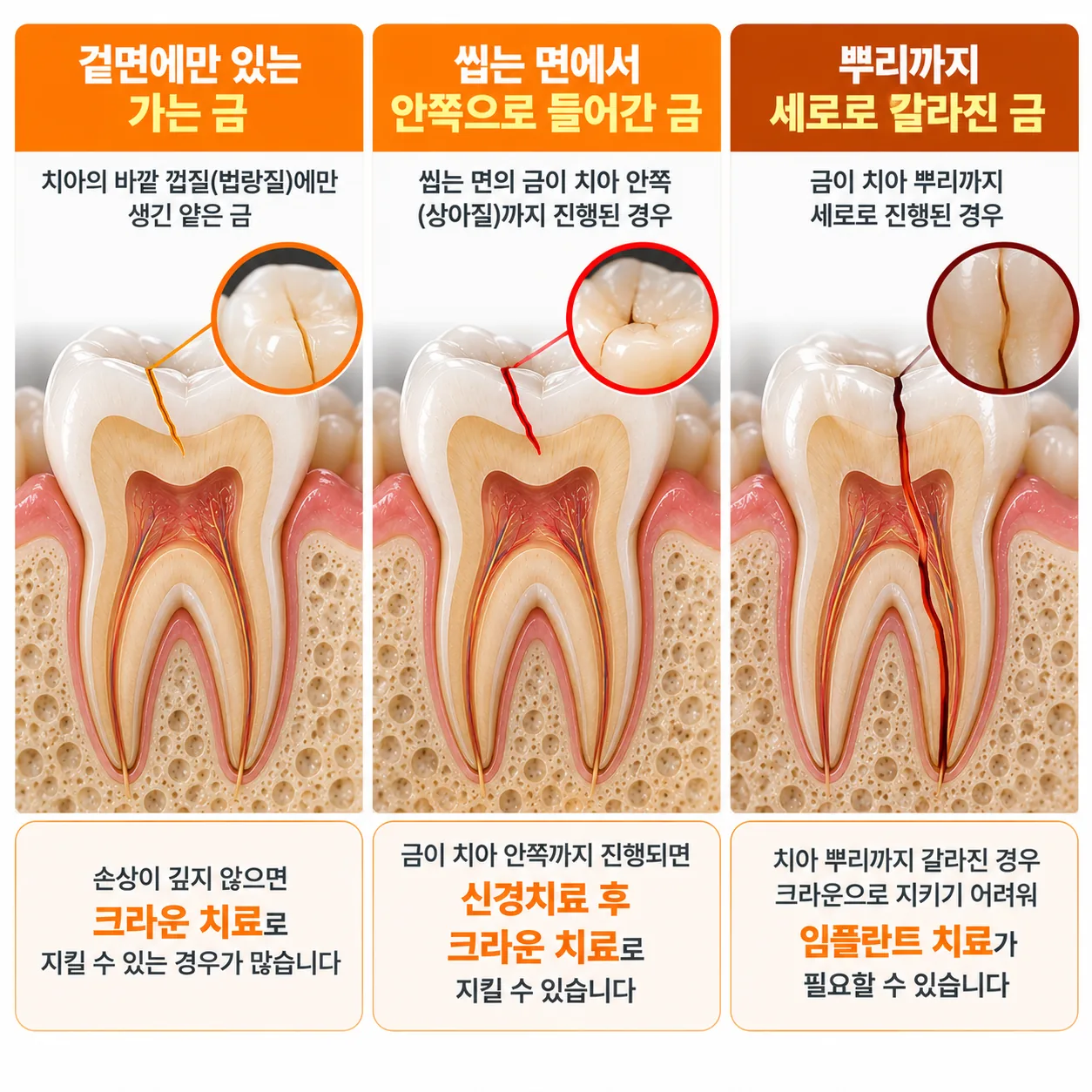 겉면의 가는 금과 안쪽으로 들어간 금, 뿌리까지 갈라진 금의 깊이를 비교한 치아 단면 도식
