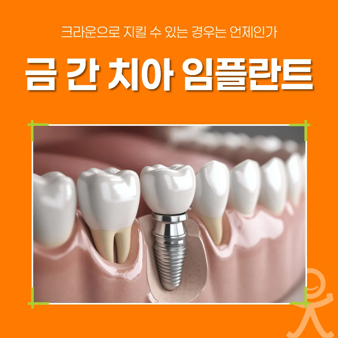 금 간 치아 임플란트, 크라운으로 지킬 수 있는 경우는 언제인가