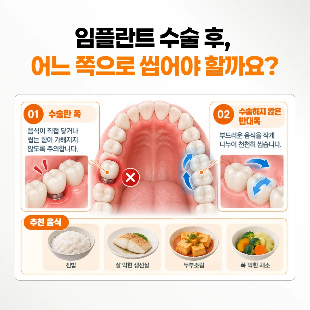 임플란트 수술 뒤 첫 며칠 반대쪽 어금니로 부드러운 음식을 씹는 방향을 표시한 치열 도식