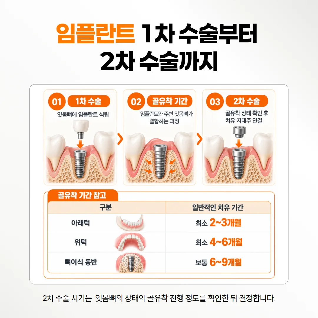 임플란트 1차 수술 뒤 잇몸뼈와 붙는 기간을 거쳐 2차 수술로 이어지는 시간 흐름 도식