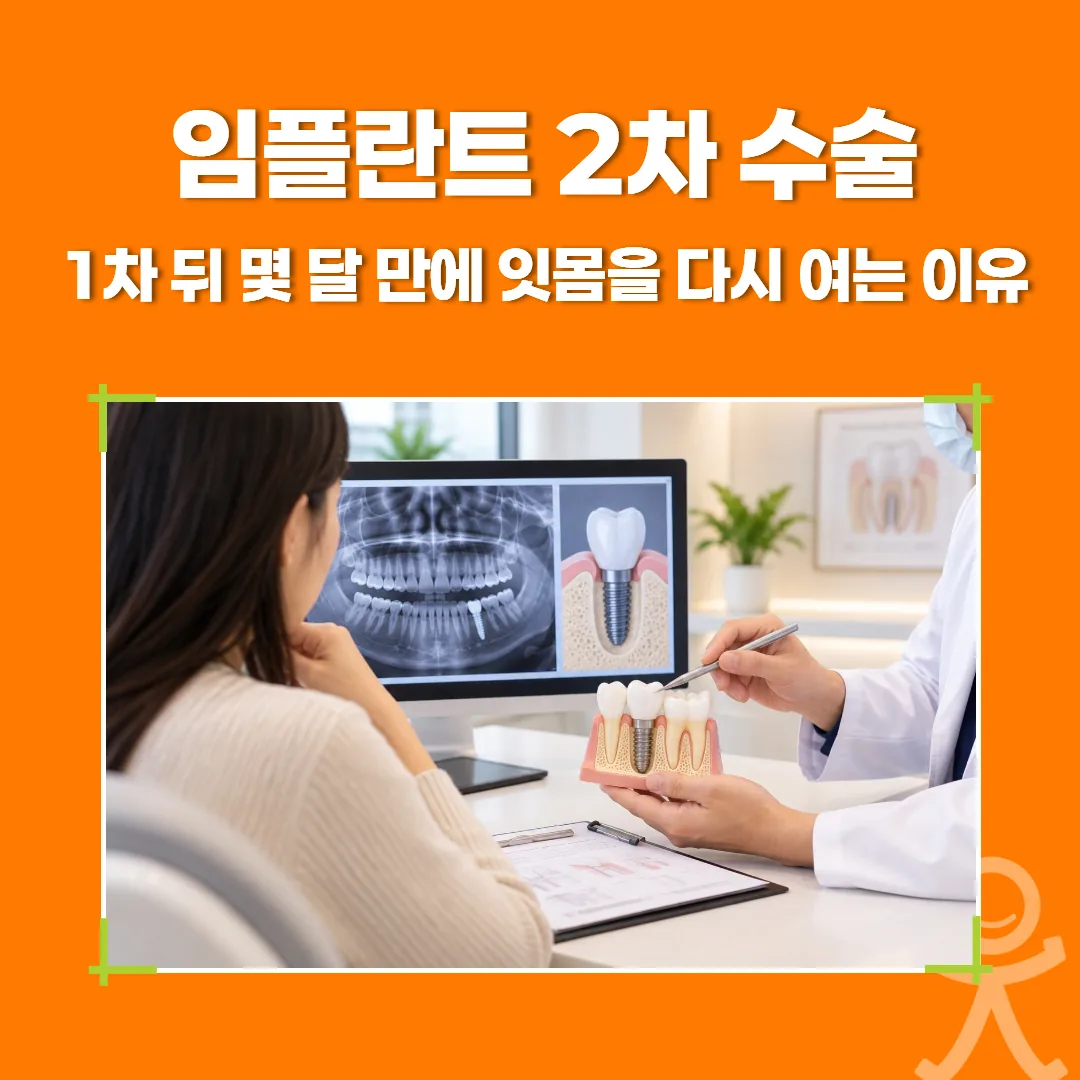 임플란트 2차 수술, 1차 뒤 몇 달 만에 잇몸을 다시 여는 이유